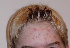 Acne Puberty