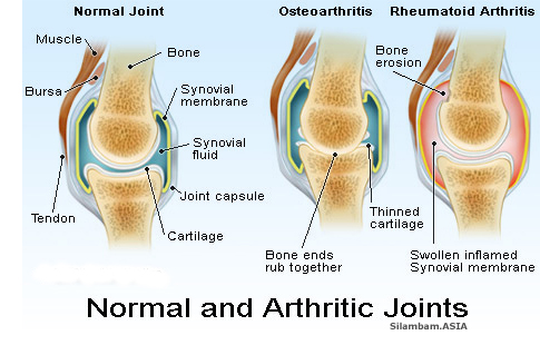 Arthritis