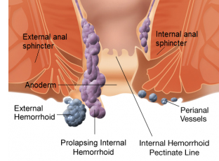 Hemorrhoids 1