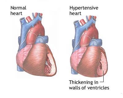 Hypertension 2