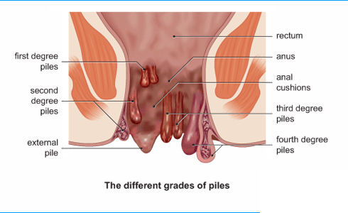 Piles