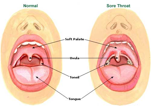 Sore Throat 2