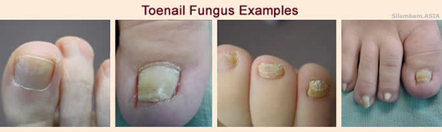 Toe Nail Fungus