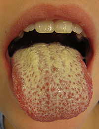 Yeast Infection - Candidiasis